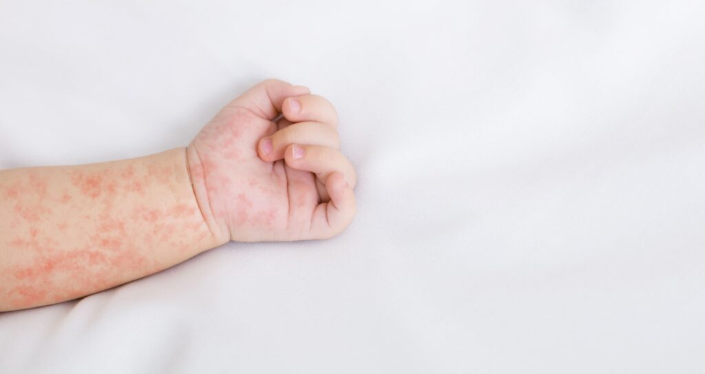 Close-up image of an infant’s arm showing a red blotchy skin rash consistent with measles symptoms.